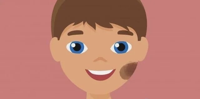 从印记到星光：一位太田痣男孩的十年激光治疗之路